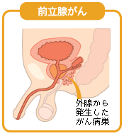 前立腺がん