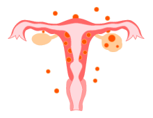 子宮内膜症のできる位置