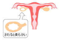 卵巣のう腫