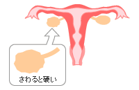 充実性腫瘍