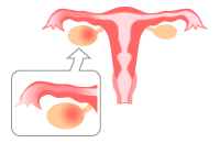 卵管炎・卵巣炎