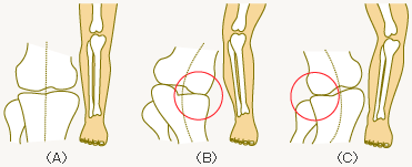 その膝痛 原因はo脚のせいかも O脚 膝のゆがみはこうして起こる Helc ヘルシー
