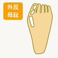 外反母趾