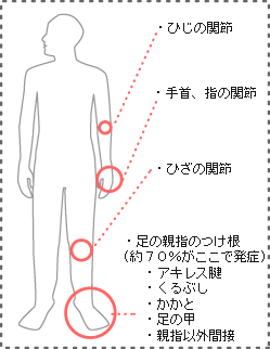 痛風のおこりやすい箇所