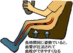 エコノミークラス症候群