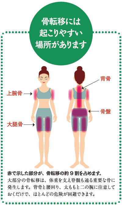 がんの骨転移で骨折や麻痺を予防するために がんロコモ対策 3 Helc ヘルシー