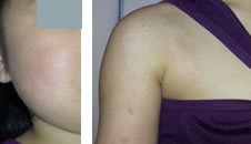 写真：湿潤治療 1年後