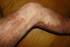 写真：火傷で皮膚移植をされた患者さん