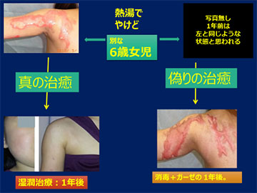 図2：熱湯でやけどの症例