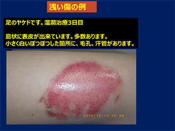 図9：浅いキズの例