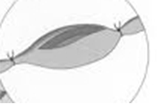 アンティルス（Antyllus）の手術（紀元2世紀）：動脈瘤の中枢側、末梢側を結紮