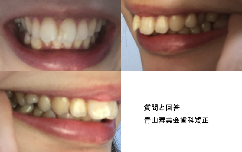前歯の片方が斜め 出っ歯です 裏側 部分 マウスピースでも矯正できますか 期間費用は コラム 専門家プロファイル