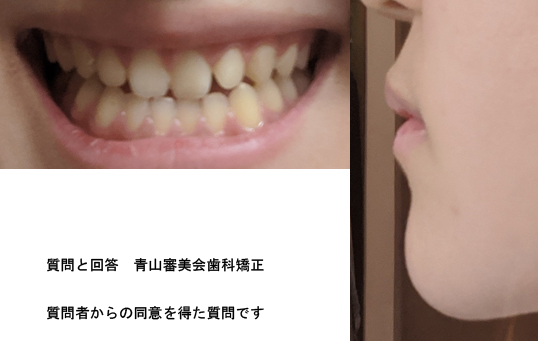 高校生 歯の位置のズレとしゃくれに悩んで 上下の奥歯が常に強く当たる状態 手術が必要 費用 コラム 専門家プロファイル 高校生 歯の位置のズレとしゃくれに悩んで 上下の奥歯が常に強く当たる状態 手術が必要 費用 コラム 専門家プロファイル