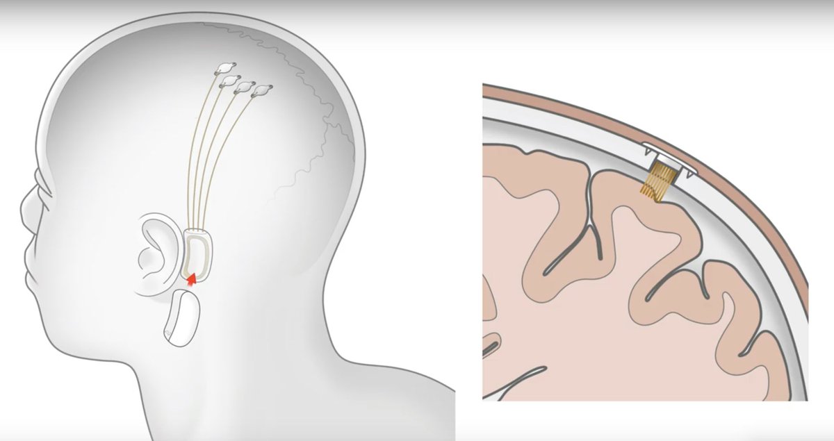   ・髪の毛より細い電極1024本を脳に埋め込む ・それらの電極で脳波を記録する ・電極で脳を直接刺激することもできる ・これらをiPhoneのアプリ上で操作できる ・来年(!)にヒトでの臨床試験を開始する 