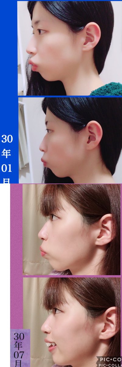 私は歯が大きく顎の長さが足りず #Eライン は出来ませんでした