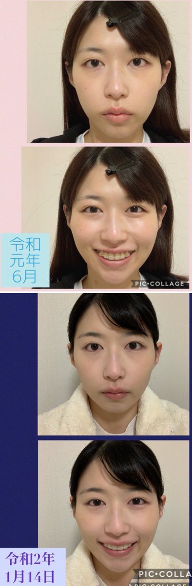 私は歯が大きく顎の長さが足りず #Eライン は出来ませんでした