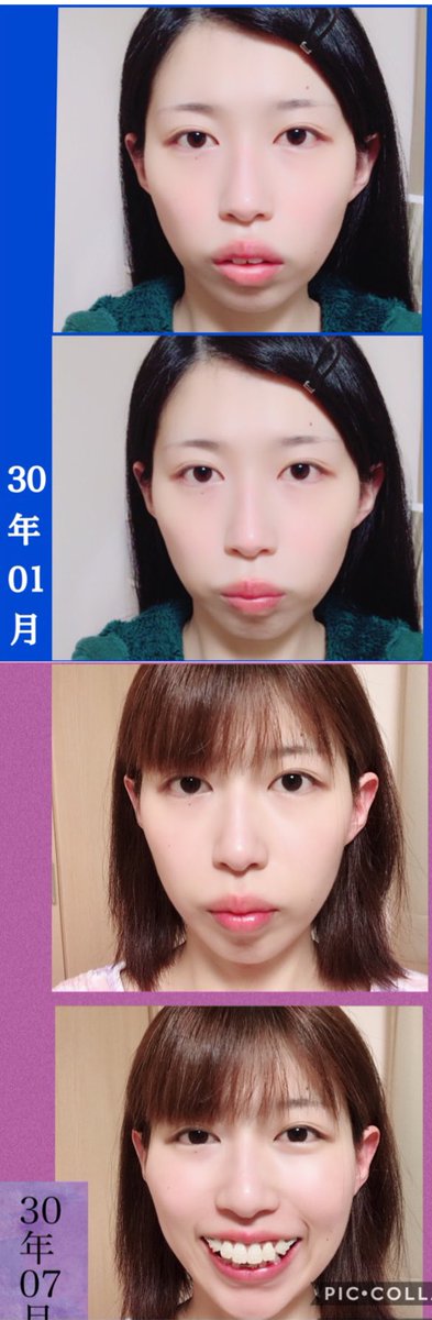 私は歯が大きく顎の長さが足りず #Eライン は出来ませんでした