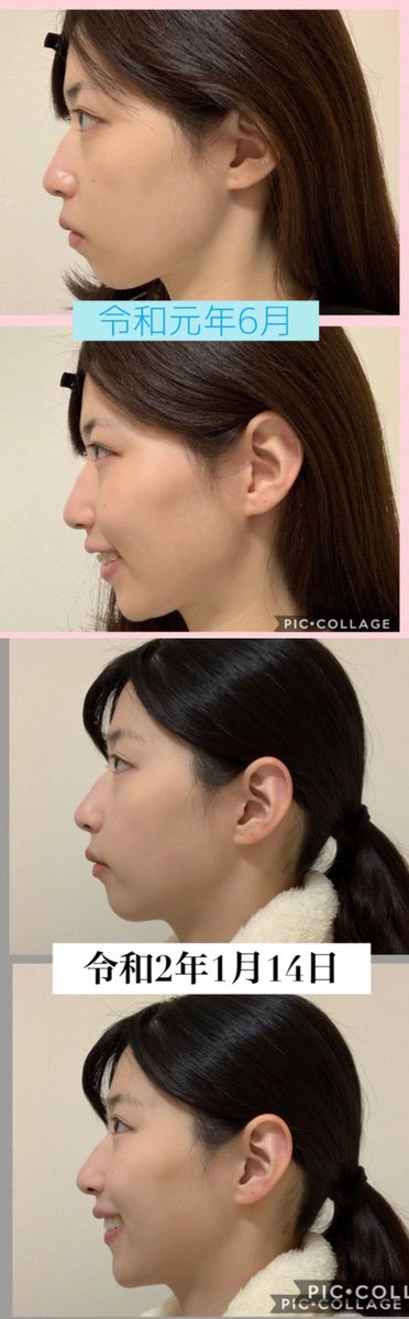 私は歯が大きく顎の長さが足りず #Eライン は出来ませんでした