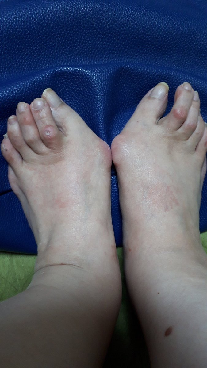 お見苦しい写真、失礼します 長年のツケ😵外反母趾の手術