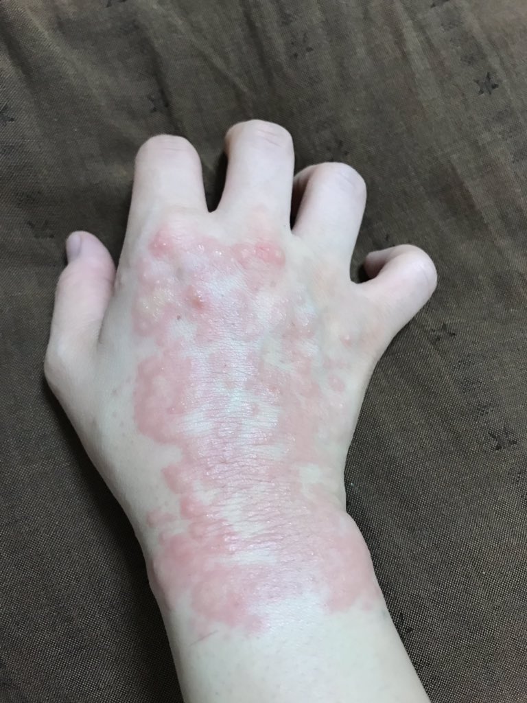 貼ってる間だけじゃなく、はがした後も1ヶ月くらいは日光に当てちゃいけないんだって