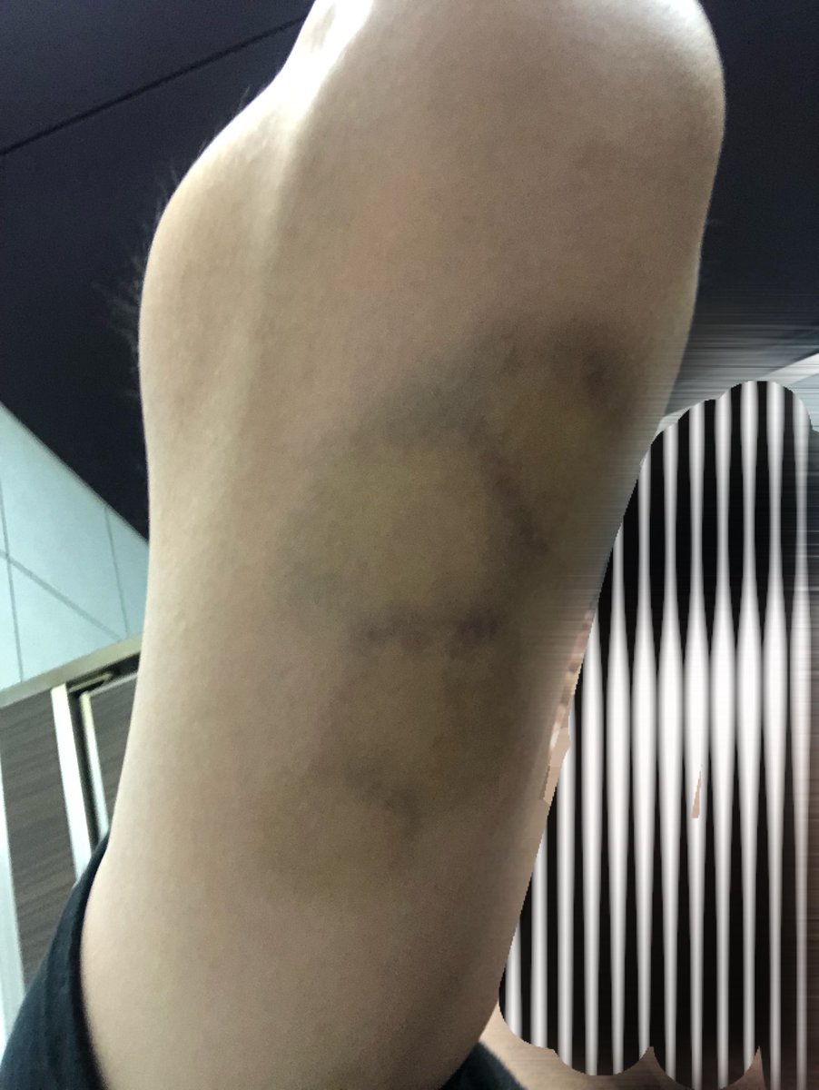 消防団の操法大会のあとの打ち上げで、ひたすら腕をつねられ、5日たってもアザが消えません