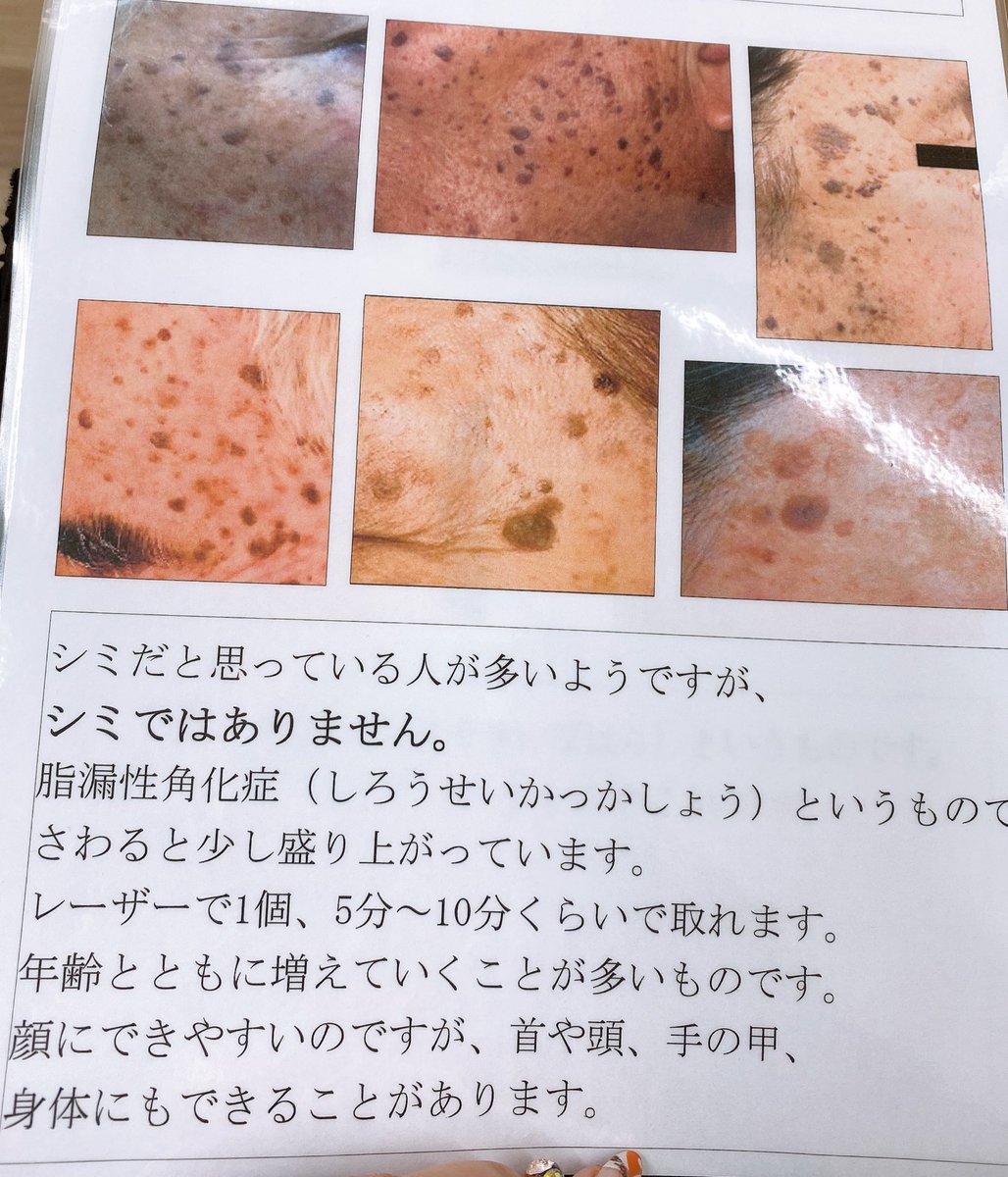 って思ってた)が、まさかの脂漏性角化症の疑い(小さいから検査しないとわからない)なので、慎重に治療を進めてもらうつもりです