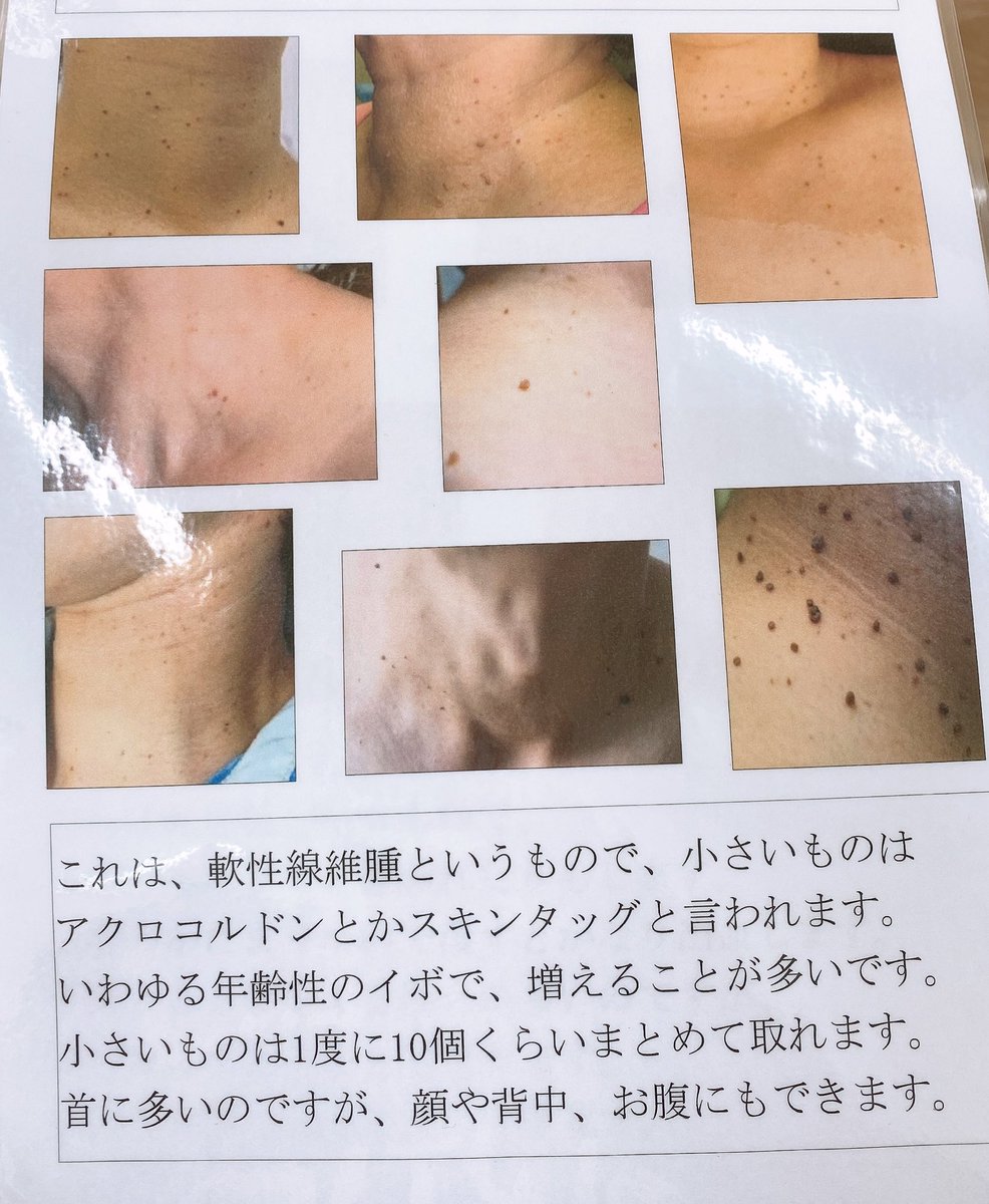 って思ってた)が、まさかの脂漏性角化症の疑い(小さいから検査しないとわからない)なので、慎重に治療を進めてもらうつもりです