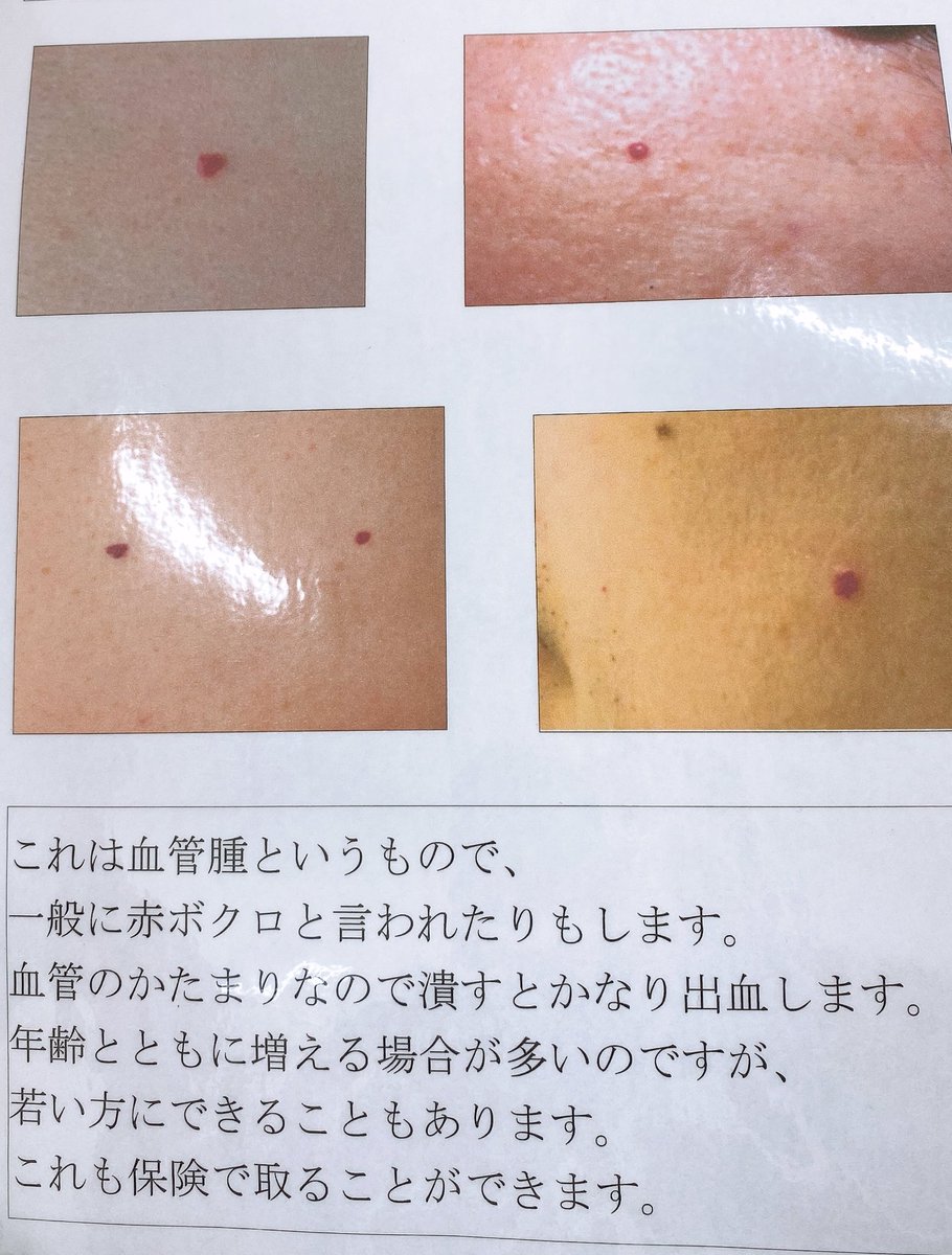 って思ってた)が、まさかの脂漏性角化症の疑い(小さいから検査しないとわからない)なので、慎重に治療を進めてもらうつもりです