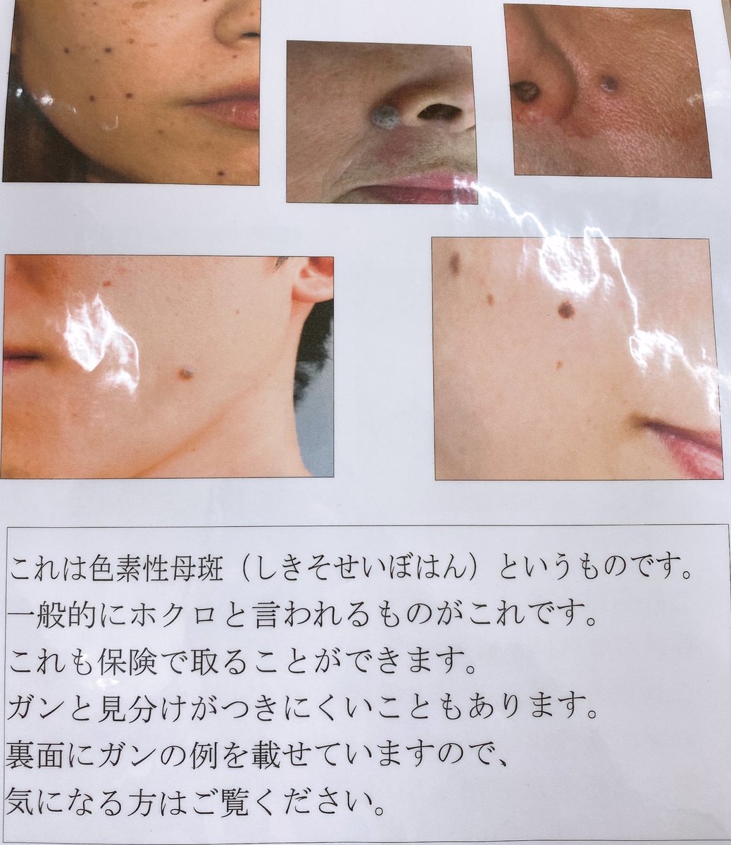 って思ってた)が、まさかの脂漏性角化症の疑い(小さいから検査しないとわからない)なので、慎重に治療を進めてもらうつもりです