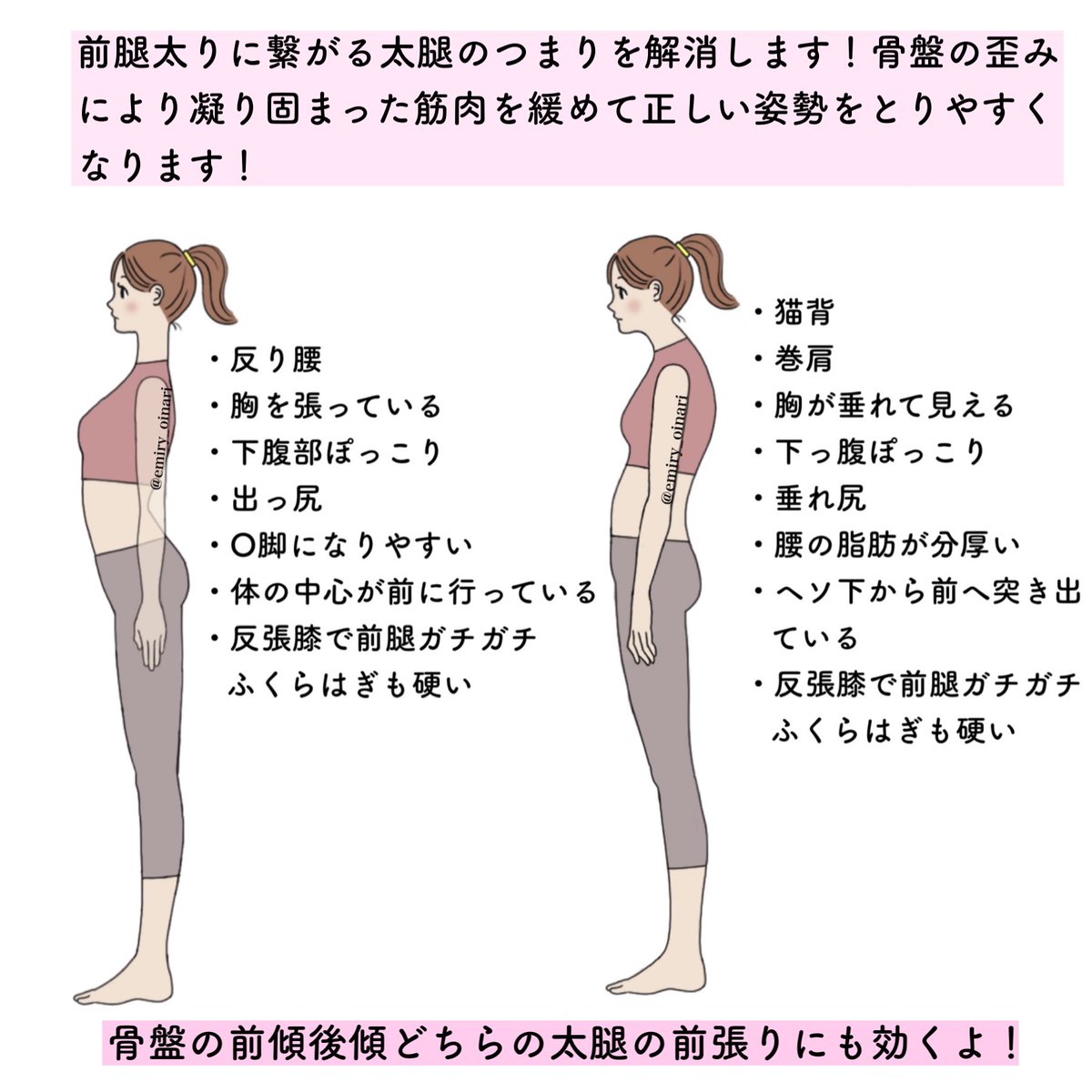 前腿の張りが気になる人は日常生活での姿勢の悪さの影響で骨盤に歪みが生じ、体の軸がブレる