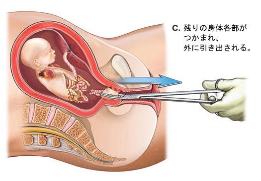   身勝手な親の快楽の為に年間16万件この手術が行われてます  避妊や中絶についてどうかもう一度考えてみて下さい 