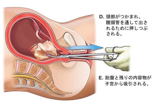   身勝手な親の快楽の為に年間16万件この手術が行われてます  避妊や中絶についてどうかもう一度考えてみて下さい 