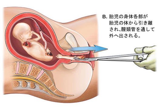   身勝手な親の快楽の為に年間16万件この手術が行われてます  避妊や中絶についてどうかもう一度考えてみて下さい 