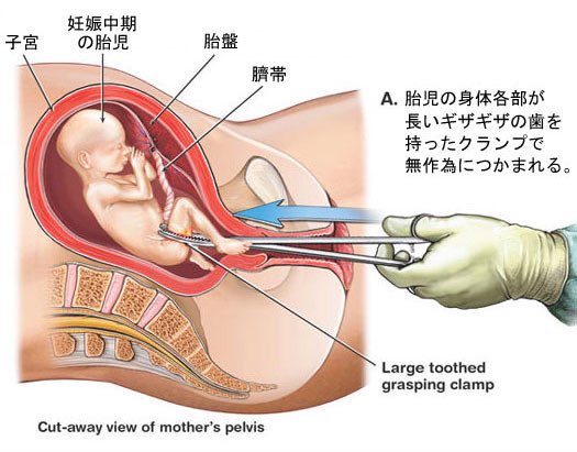   身勝手な親の快楽の為に年間16万件この手術が行われてます  避妊や中絶についてどうかもう一度考えてみて下さい 