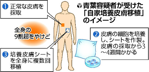 【京アニ放火事件】青葉容疑者、死亡率95%超だった 医師が明かす 治療にあたった医師の一人は「治療に力を尽くしたのは、被害者と真相解明のためだ