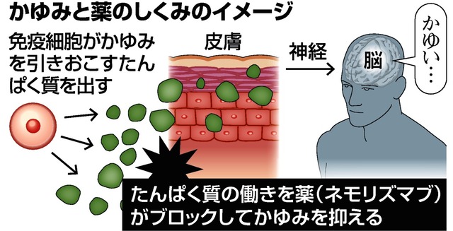 【米医学誌に発表】アトピーの新薬、京大など治験で効果を確認 かゆみは注射1日後から改善され、重い副作用はみられなかったという