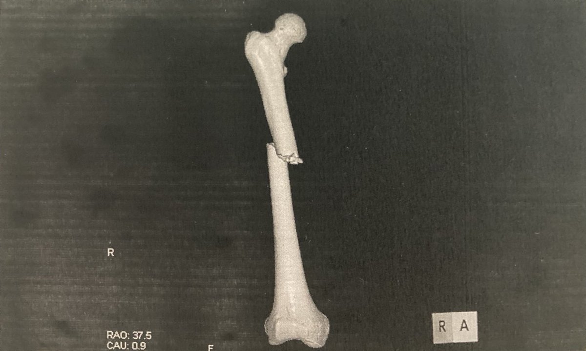 太ももの骨折った日に撮ったレントゲンをズボンにした 