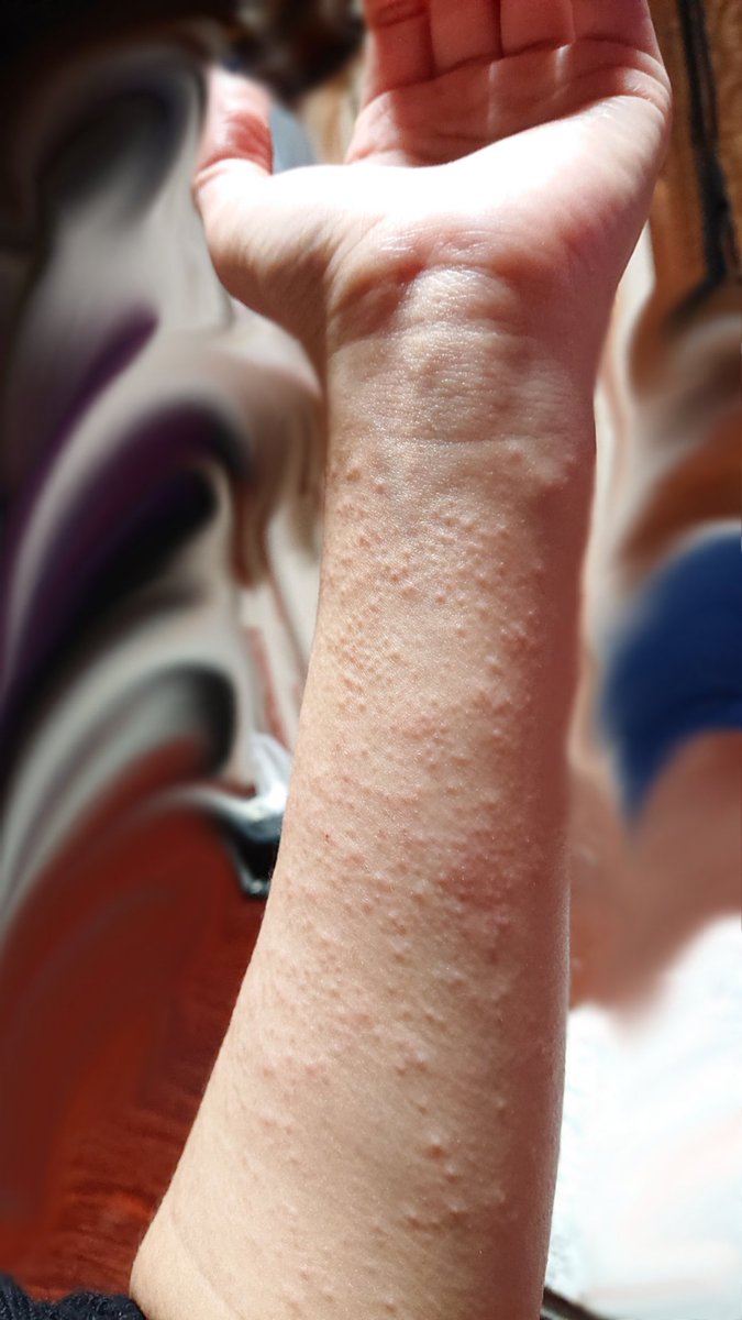 ラベンダーカラーの…肌綺麗にって日焼け止め使ったら…こうなったので；；肌弱い人々気を付けて