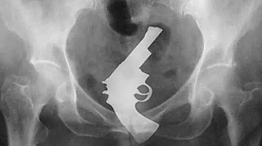 お尻に異物を入れた患者のレントゲン写真、たまにアルバムジャケットにしたいぐらいカッコイイ構図の奴があるから困る