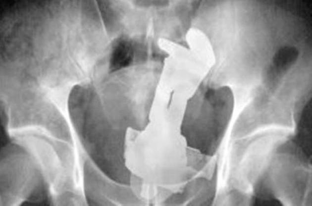 お尻に異物を入れた患者のレントゲン写真、たまにアルバムジャケットにしたいぐらいカッコイイ構図の奴があるから困る