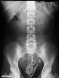 お尻に異物を入れた患者のレントゲン写真、たまにアルバムジャケットにしたいぐらいカッコイイ構図の奴があるから困る