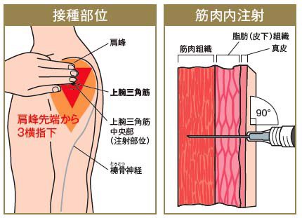 今までのインフルエンザのような予防接種は皮下注がほとんどだったけど今度の新型コロナワクチンの予防接種は筋注 なので上腕の肩峰3横指下に90°でブスッといきます 結構腕の上の方です 袖を捲りあげやすい服だと施行側はとてもありがたいです 