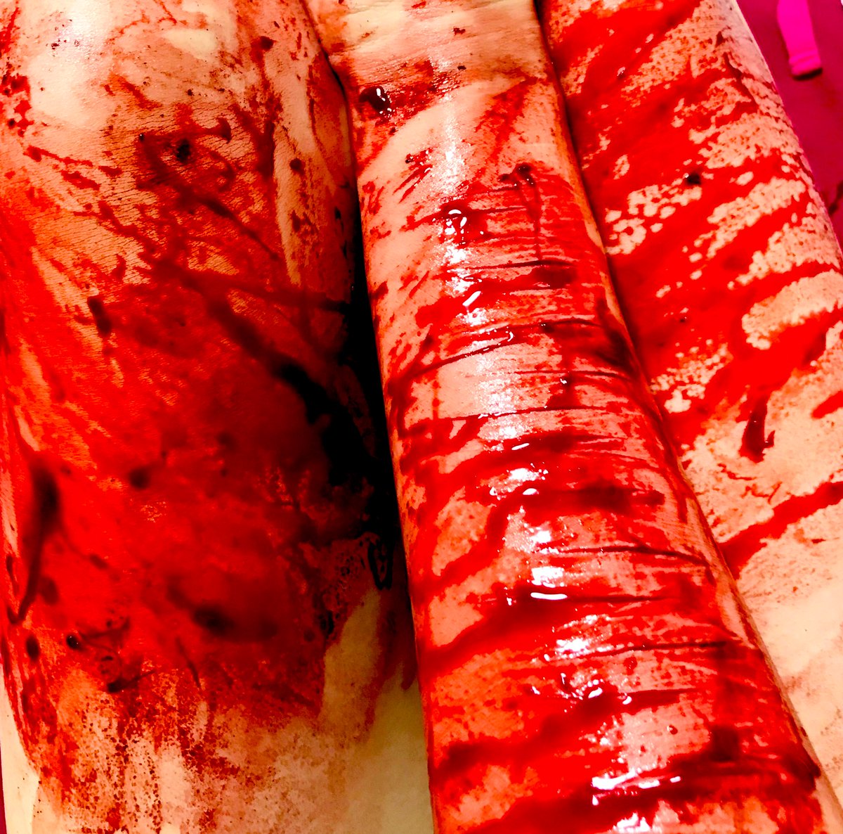 あいつの目の前でリスカしてやった、笑 境界性人格障害、悪化しそう^^