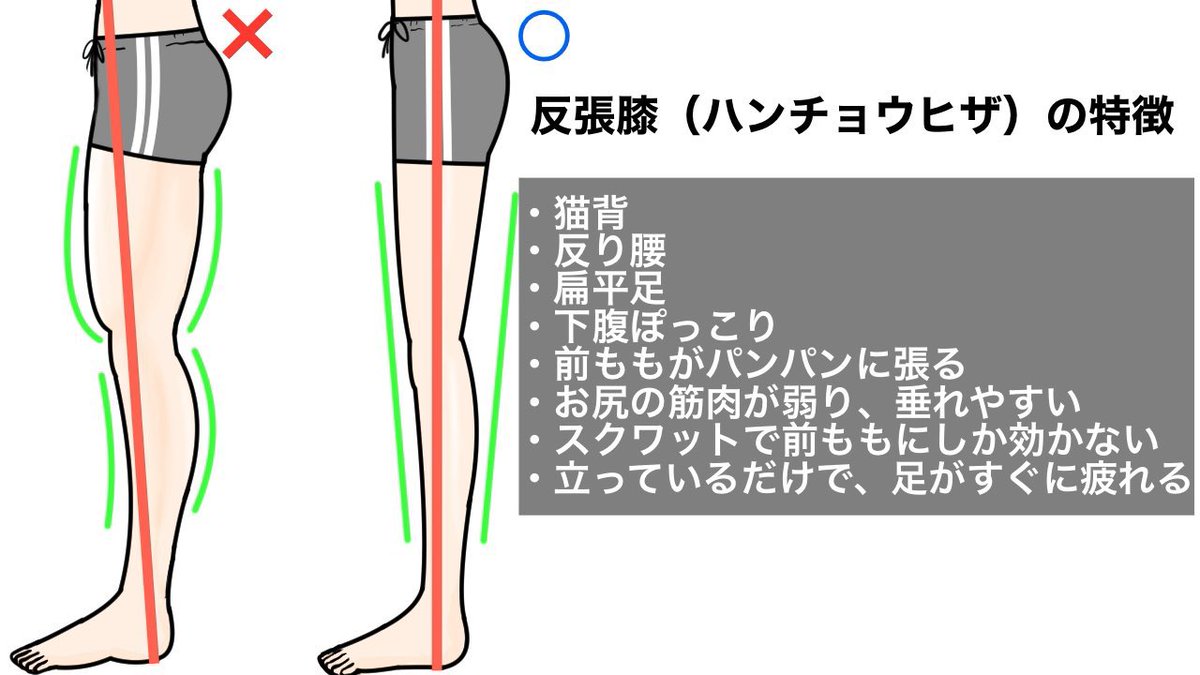 99%の反り腰の方に当てはまる、ひざがピンと伸びている「反張膝」の姿勢はマジで厄介