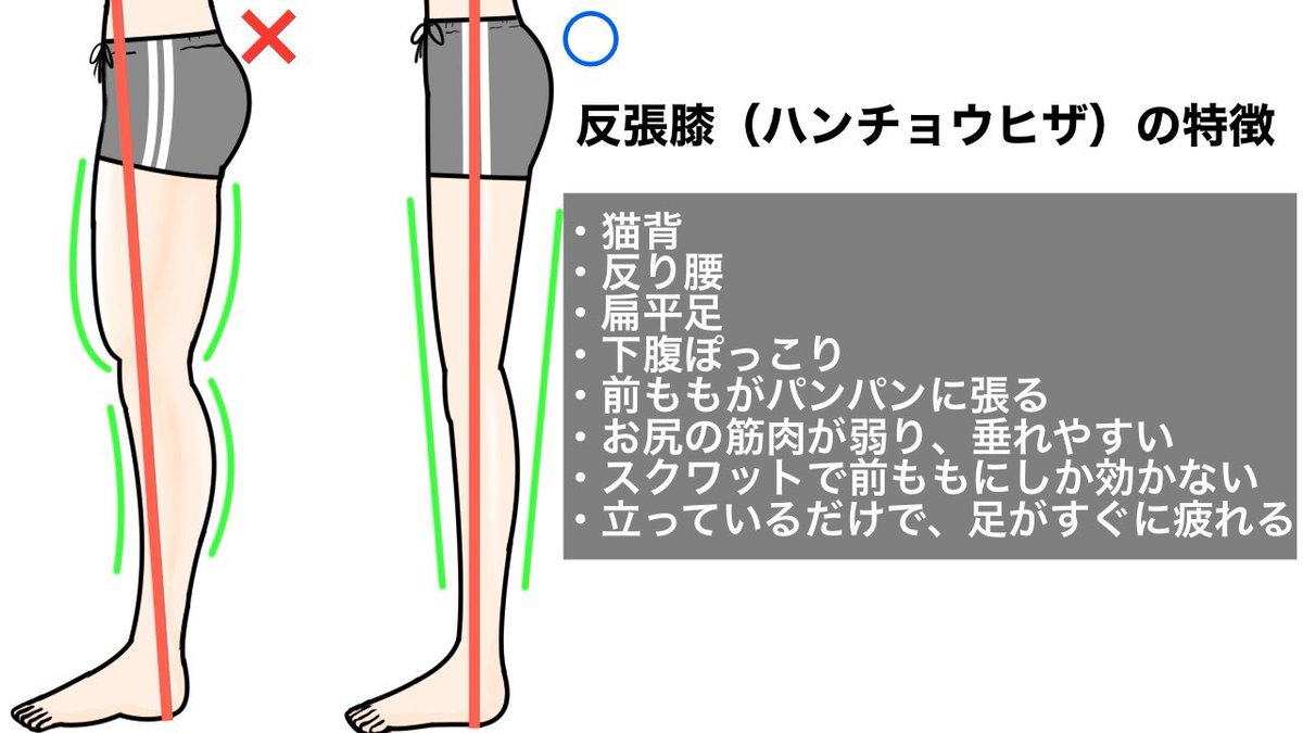 ９９%の反り腰の方に当てはまる、ひざがピンと伸びている「反張膝」の姿勢はマジで厄介