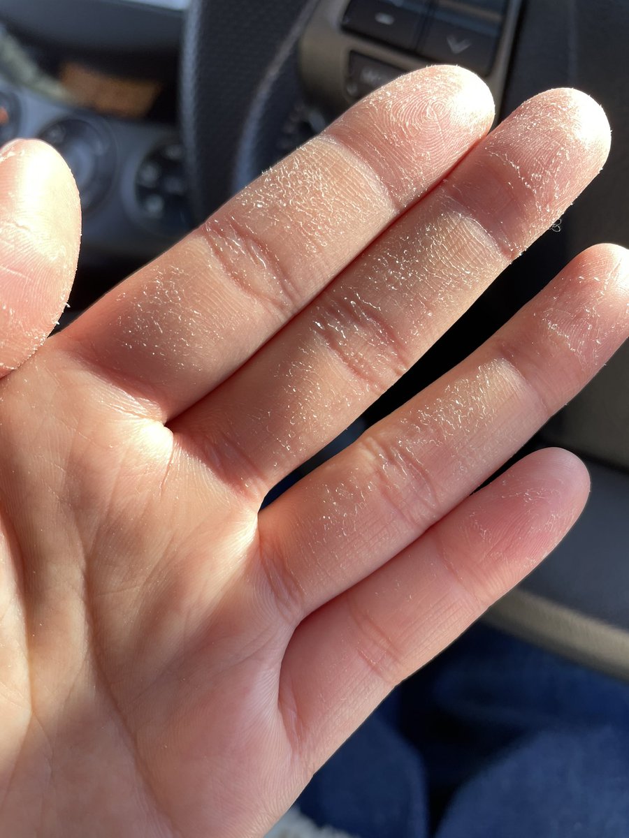 これがコロナ禍の看護師(24歳女)の手です。ご査収ください。 