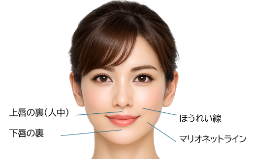 表皮から届かない層に、口の中からリフトアップ
