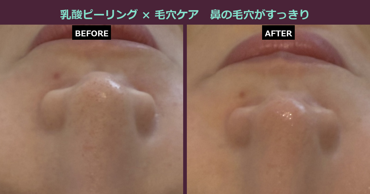 【三軒茶屋フェイシャル】鼻の毛穴のざらつき、諦めていませんか?