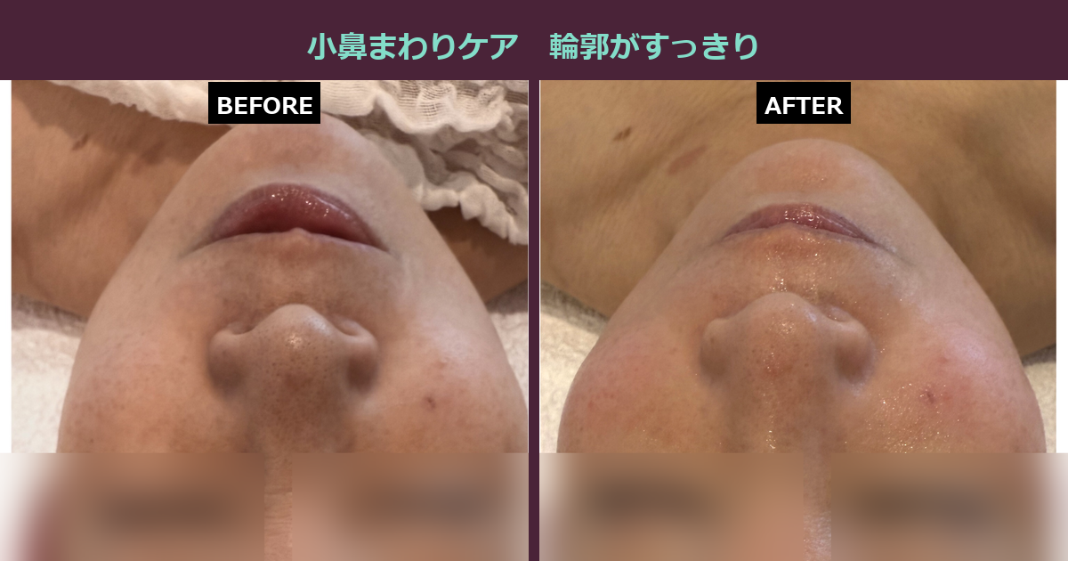 【三軒茶屋フェイシャル】小鼻の広がり、諦めていませんか?