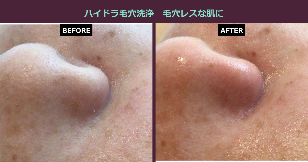 【三軒茶屋フェイシャル】毛穴の黒ずみ、諦めていませんか?